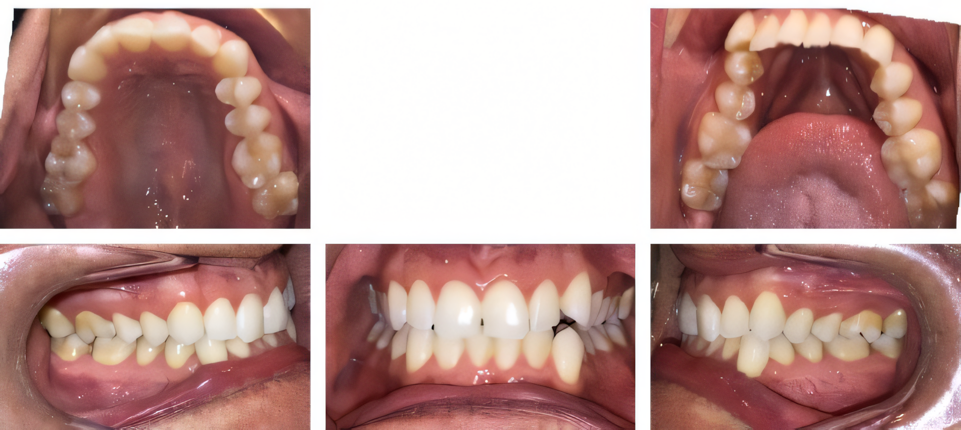 Invisalign for adults before